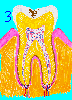 Enamel Tooth Decay