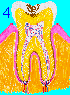 Dentine Tooth Decay