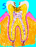 Cavity Tooth Decay