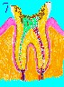 Deep Tooth Decay