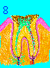 Very Deep Tooth Decay