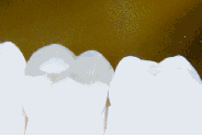 porcelaincrownpng