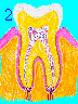 Early Gingivitis