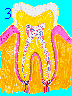 Gingivitis