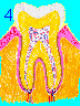 Late Gingivitis