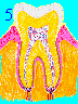 Early Gum Disease