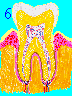Gum Disease